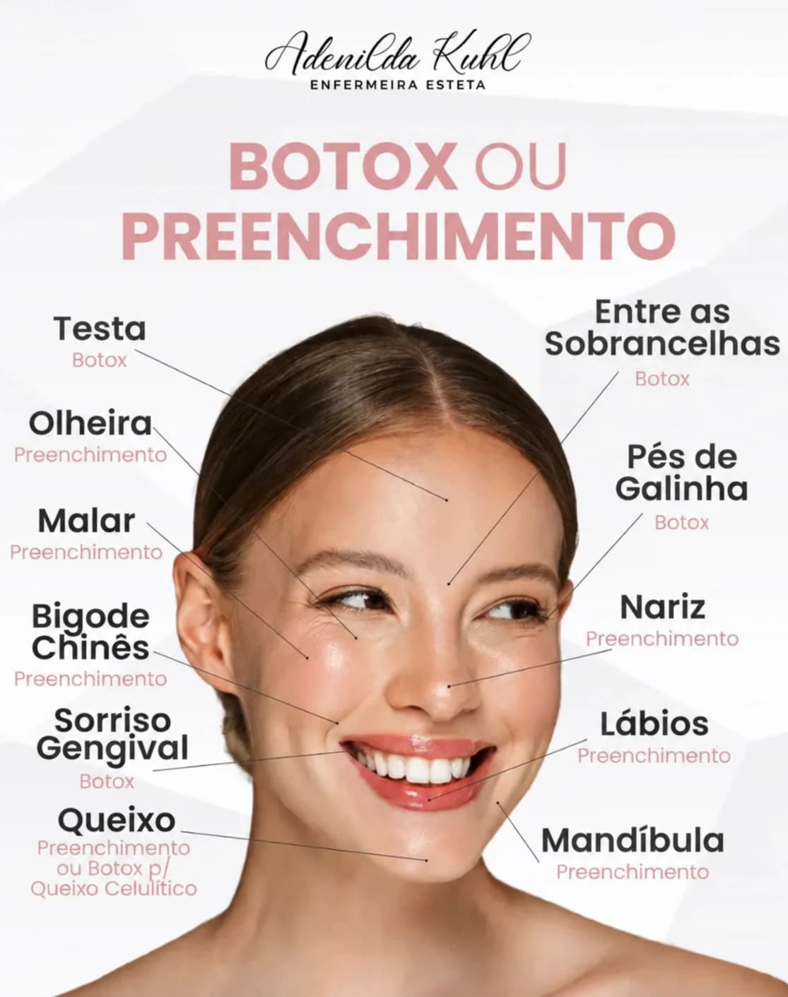 Guia de Adenilda Kuhl: regiões do rosto e o tratamento mais comum em cada uma, botox ou preenchimento