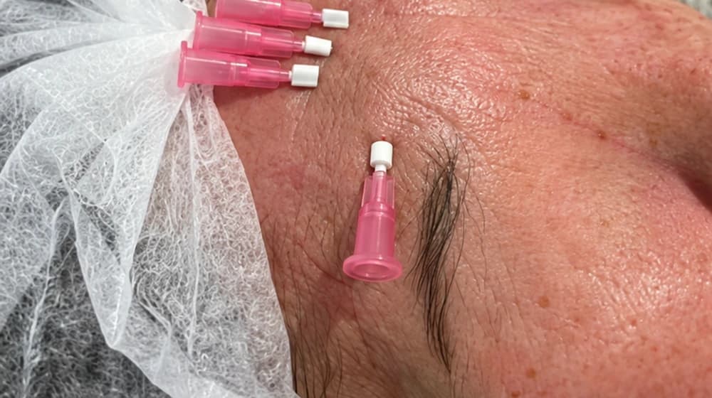 Fios lisos de PDO na região superior da face, na área do músculo prócero (entre as sobrancelhas e acima da raiz do nariz). Com o envelhecimento, a produção de colágeno diminui gradualmente. O tratamento busca estimular a renovação do colágeno e melhorar a qualidade da pele nessa região.