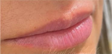Preenchimento labial: antes