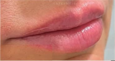 Preenchimento labial: pós-imediato