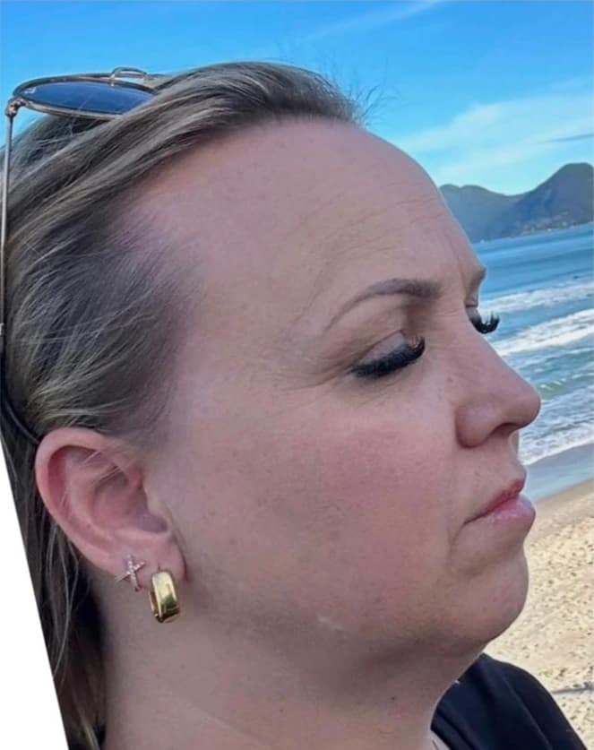 Harmonização facial — região mentoniana (queixo), contorno e lábios: antes