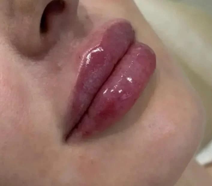 Preenchimento labial — detalhe dos lábios