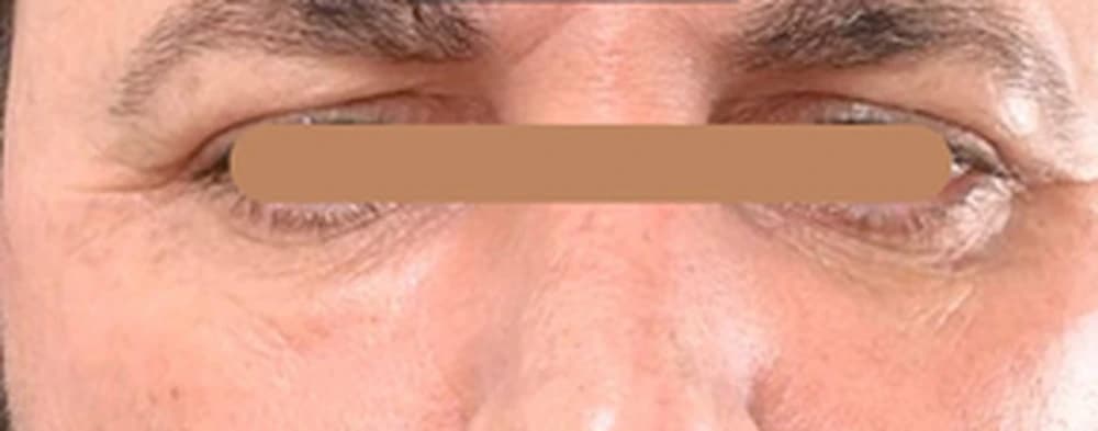 Preenchimento da região infraorbital (olheiras) — Masculino: depois