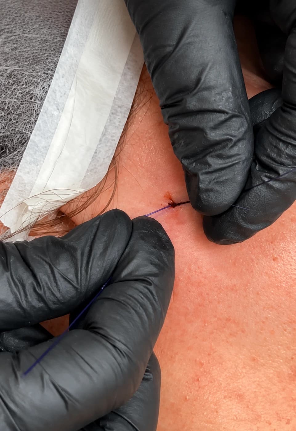 Após passar o fio, faço uma tração e a amarração para reposicionar os tecidos e dar sustentação à região tratada.
