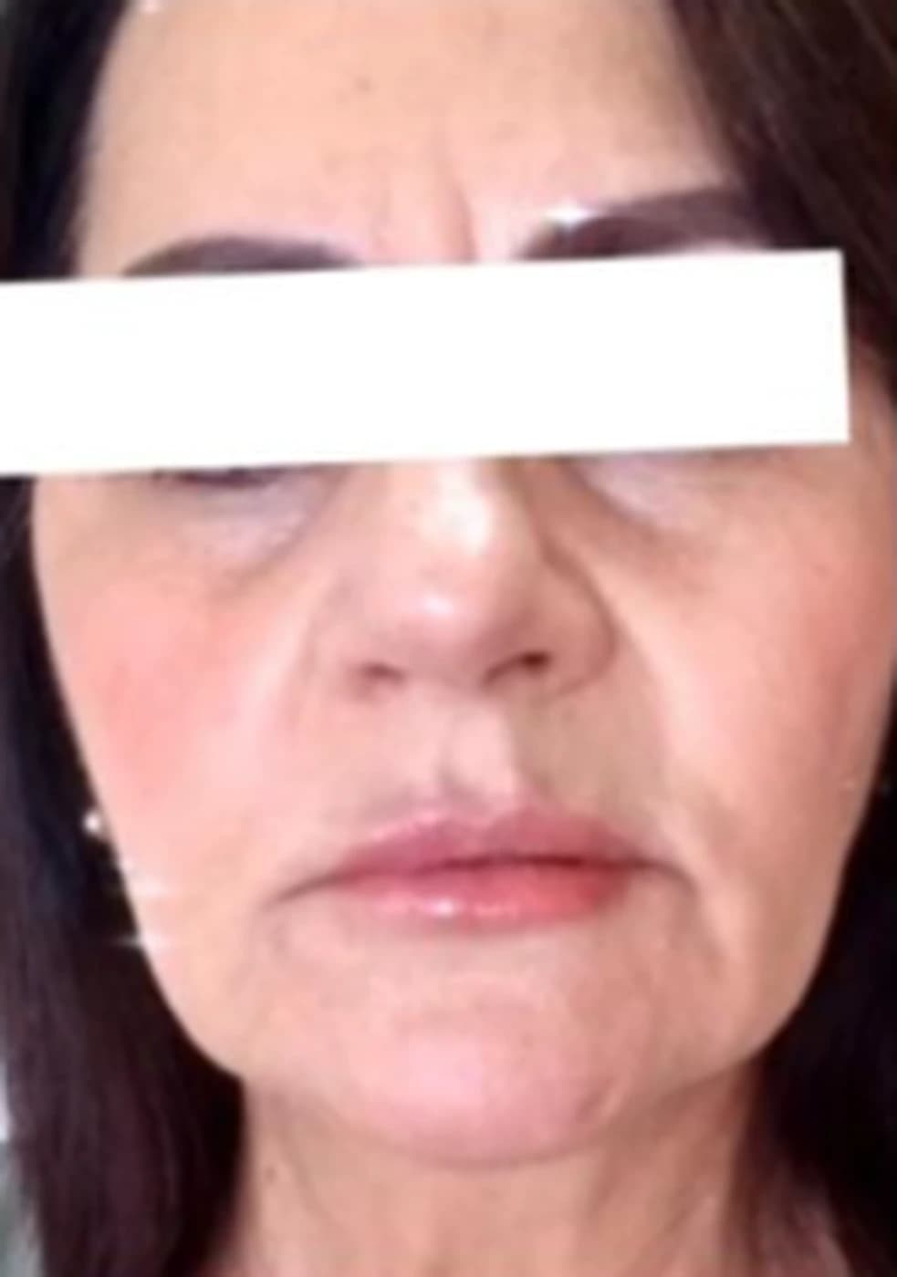 Harmonização facial: depois