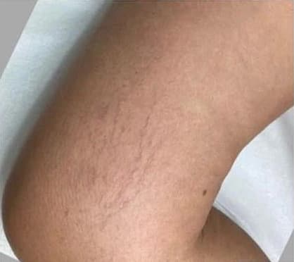 Secagem de vasinhos em membros inferiores (PEIM) — vista lateral: antes