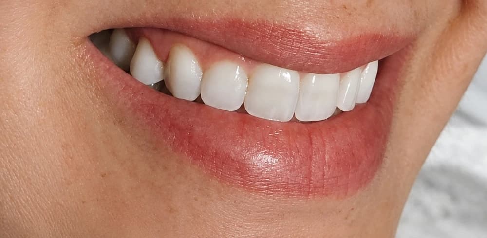 Correção do sorriso gengival: outro enquadramento do sorriso