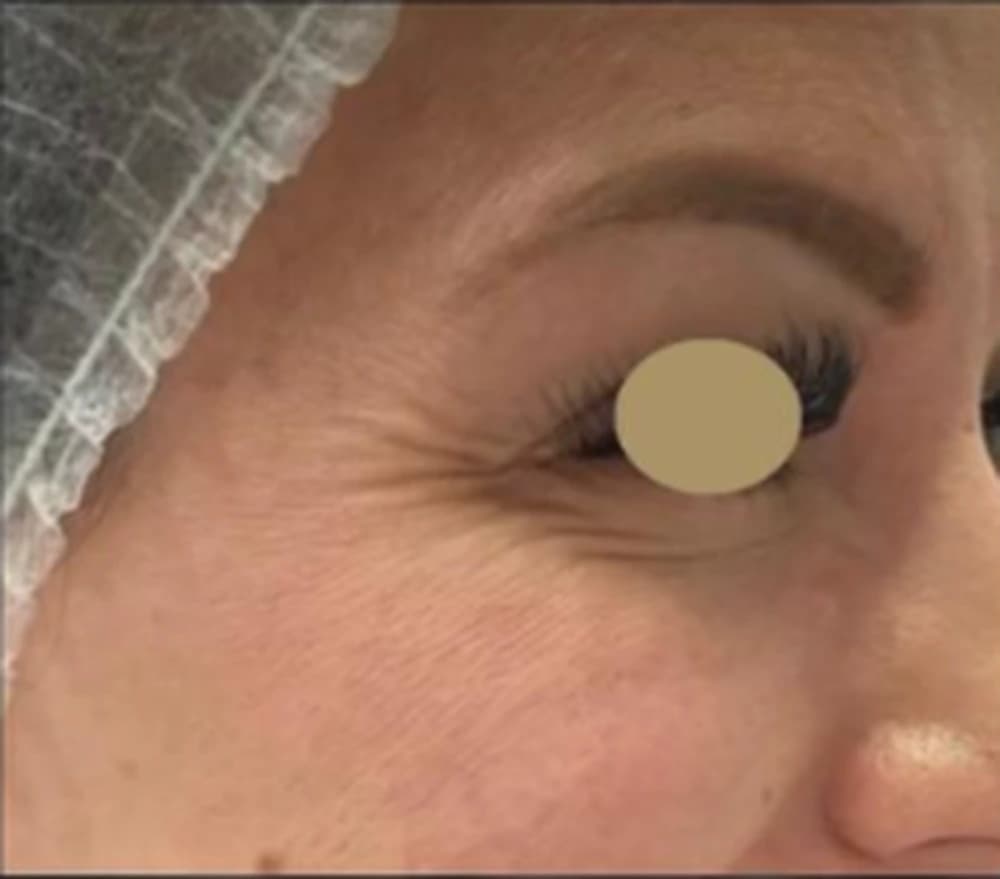 Toxina botulínica na região periorbital lateral (pés de galinha): antes