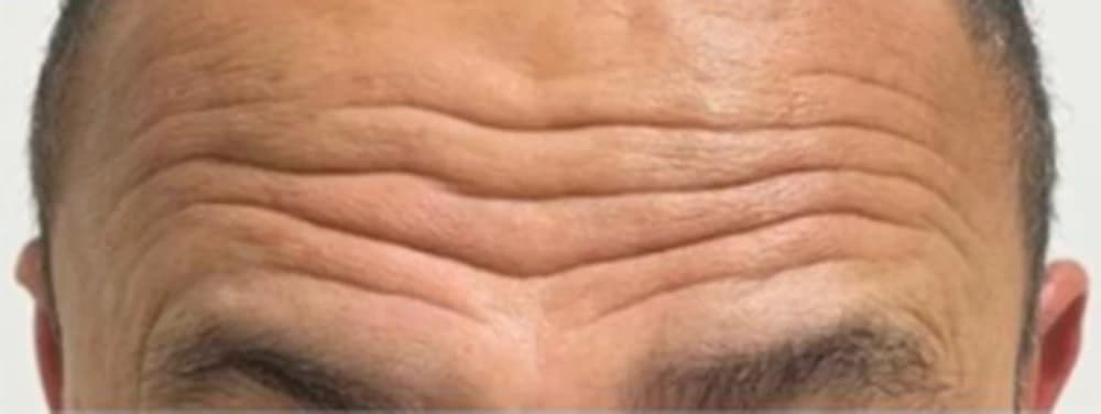 Toxina botulínica na região frontal (testa) — Masculino: antes