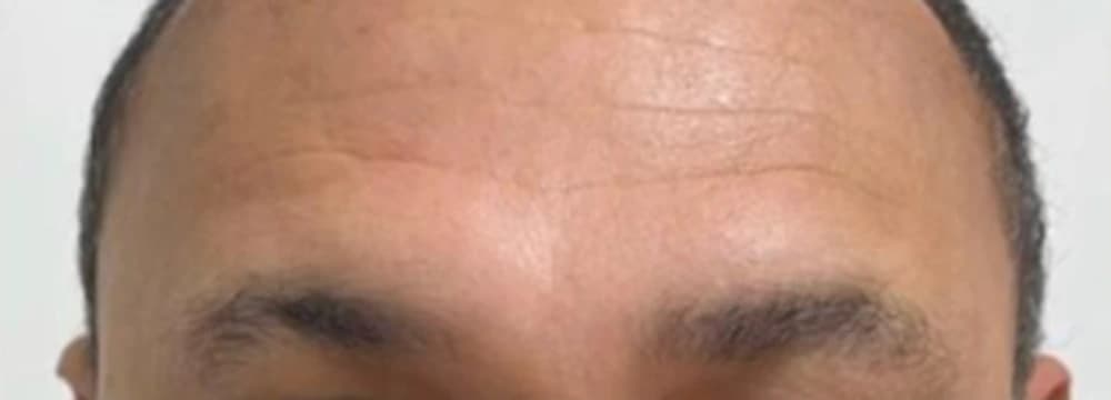 Toxina botulínica na região frontal (testa) — Masculino: depois