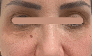 Preenchimento da região infraorbital (olheiras) — Feminino: depois