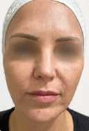 Harmonização facial: depois