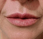Preenchimento labial: depois