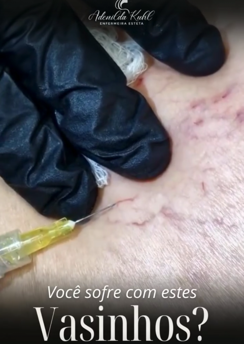 Close de aplicação de PEIM: mãos com luvas e seringa junto aos vasinhos