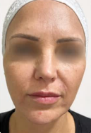 Harmonização facial: registro depois do procedimento