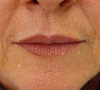Preenchimento labial: registro antes do procedimento
